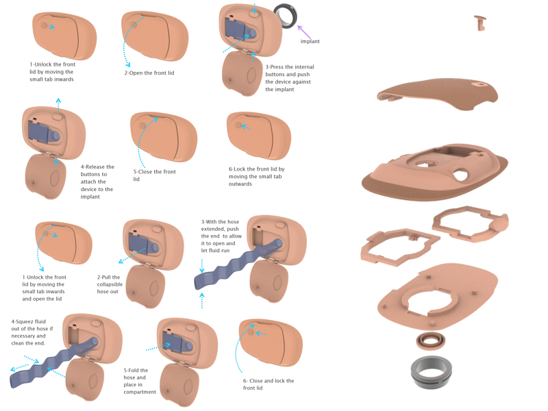 Mechanical Engineering — Colostomy